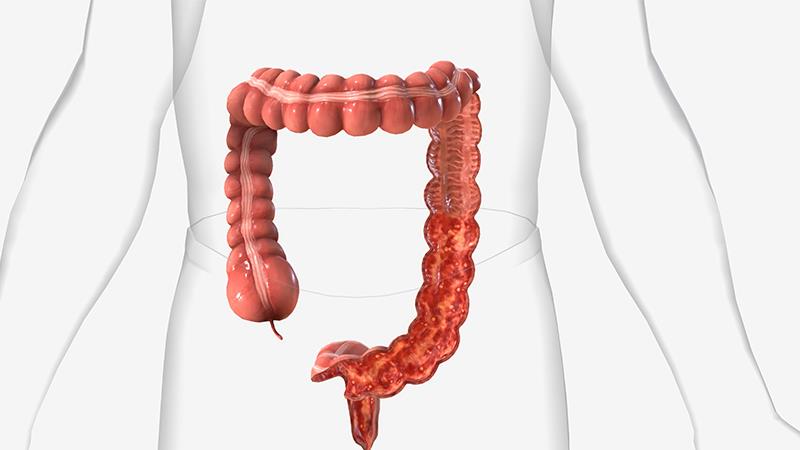 Risankizumab as induction therapy induces clinical remission in UC