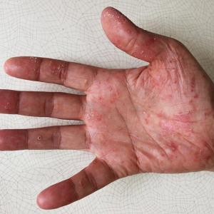 Risankizumab eases symptoms in nonpustular palmoplantar psoriasis