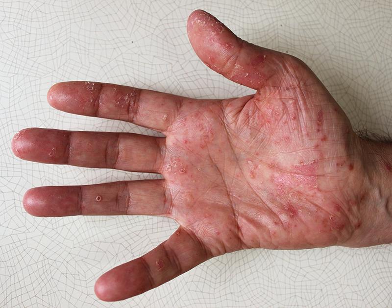 Risankizumab eases symptoms in nonpustular palmoplantar psoriasis