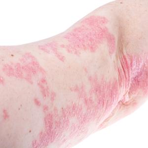 Ebdarokimab works wonders for patients with plaque psoriasis