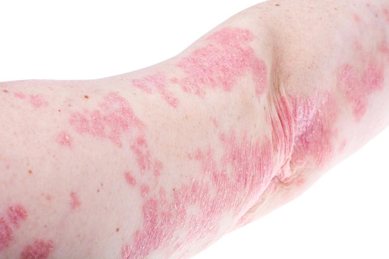 Ebdarokimab works wonders for patients with moderate/severe plaque psoriasis