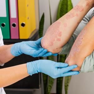 Risankizumab trumps ustekinumab, placebo for moderate-to-severe psoriasis