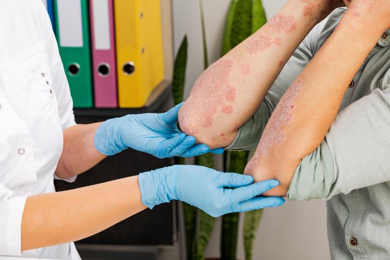 Risankizumab trumps ustekinumab, placebo for moderate-to-severe psoriasis