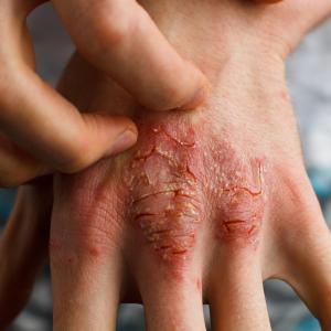 OASIS-1: Thumbs up for mirikizumab in moderate-to-severe plaque psoriasis