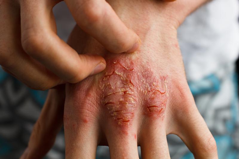 OASIS-1: Thumbs up for mirikizumab in moderate-to-severe plaque psoriasis