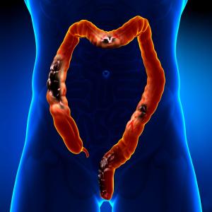 Maintenance subcutaneous vedolizumab effective in moderately, severely active ulcerative colitis