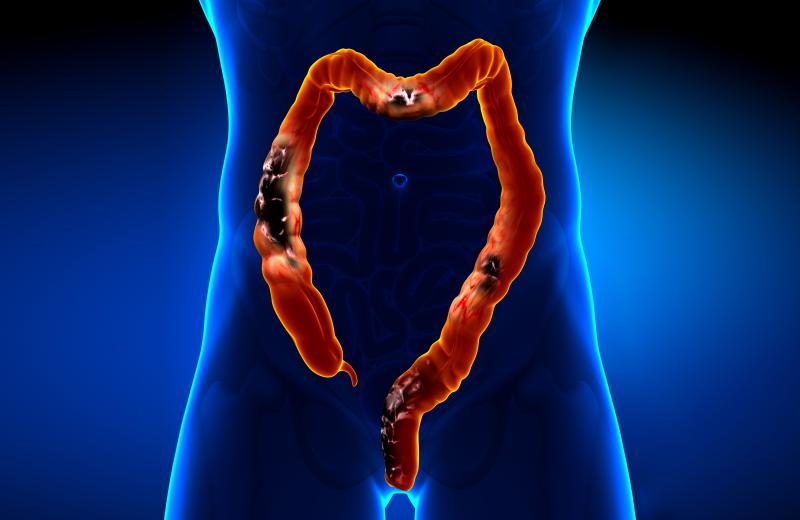 Maintenance subcutaneous vedolizumab effective in moderately, severely active ulcerative colitis