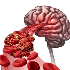 AF patients with VTE history at high risk of stroke, systemic embolism