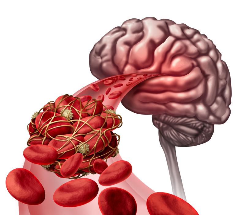 AF patients with VTE history at high risk of stroke, systemic embolism