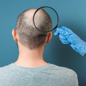 Oral minoxidil may be a viable alternative to topical treatment for male pattern baldness