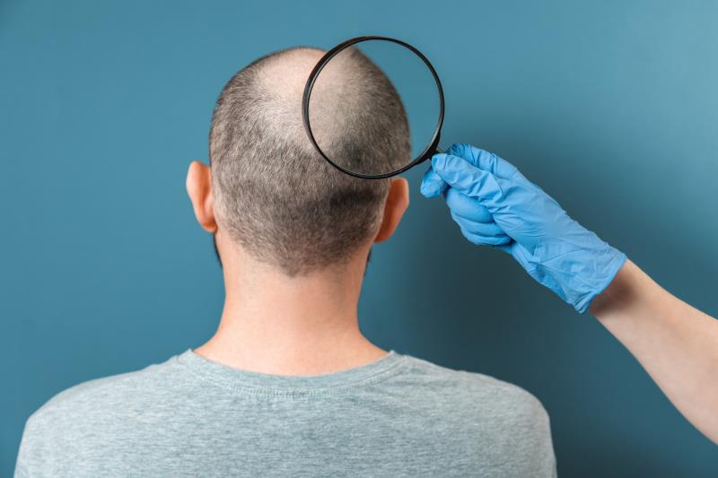 Oral minoxidil may be a viable alternative to topical treatment for male pattern baldness