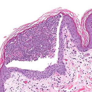 Rituximab yields cardiometabolic protection in pemphigus patients