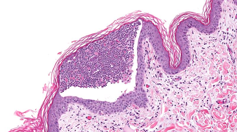 Rituximab yields cardiometabolic protection in pemphigus patients