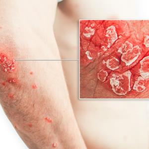 Roflumilast cream reduces psoriasis severity