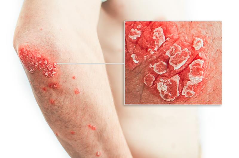 Roflumilast cream reduces psoriasis severity