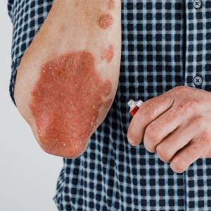 Biologics cut mortality risk in psoriasis regardless of treatment duration