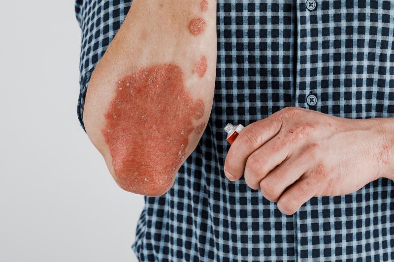 Biologics cut mortality risk in psoriasis regardless of treatment duration