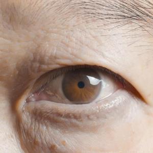 Newly diagnosed glaucoma ups risk of dementia