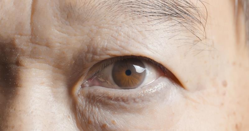 Newly diagnosed glaucoma ups risk of dementia