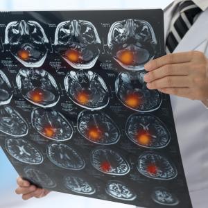 Intracranial bleeding rare among older fall patients