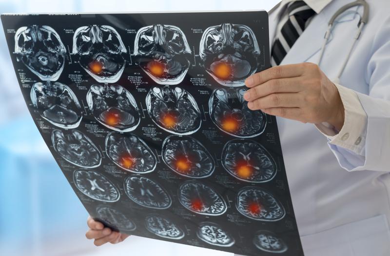 Intracranial bleeding rare among older fall patients