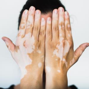 Ruxolitinib improves repigmentation in vitiligo through 52 weeks