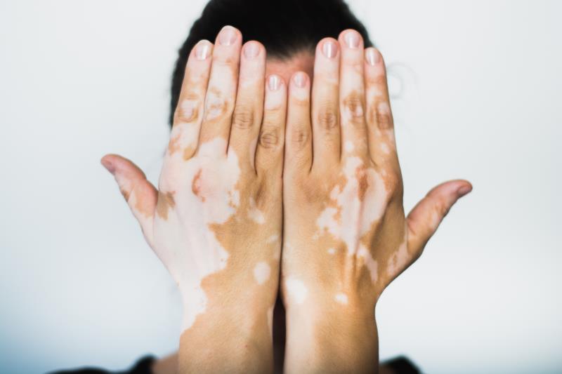 Ruxolitinib improves repigmentation in vitiligo through 52 weeks