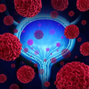 Cisplatin-based chemotherapy boosts survival in muscle-invasive bladder cancer