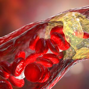 IVL maintains superiority over PTA at 1 year for peripheral artery calcification