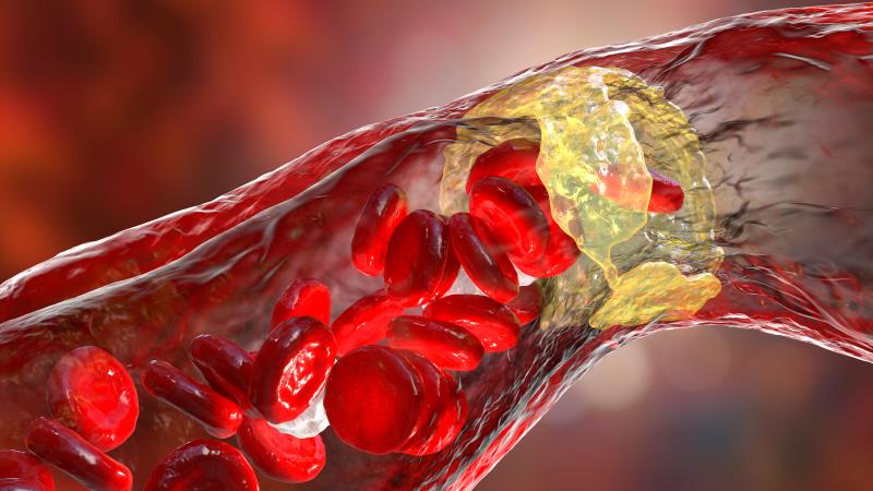 IVL maintains superiority over PTA at 1 year for peripheral artery calcification