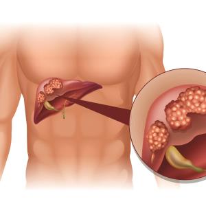 Second-line NIVO + IPI combo sustains response, OS benefit in aHCC