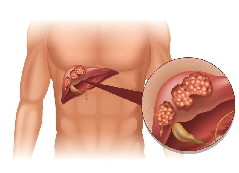 Second-line NIVO + IPI combo sustains response, OS benefit in aHCC