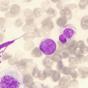 Second-line tisagenlecleucel renders no EFS benefit in aggressive B-cell lymphoma