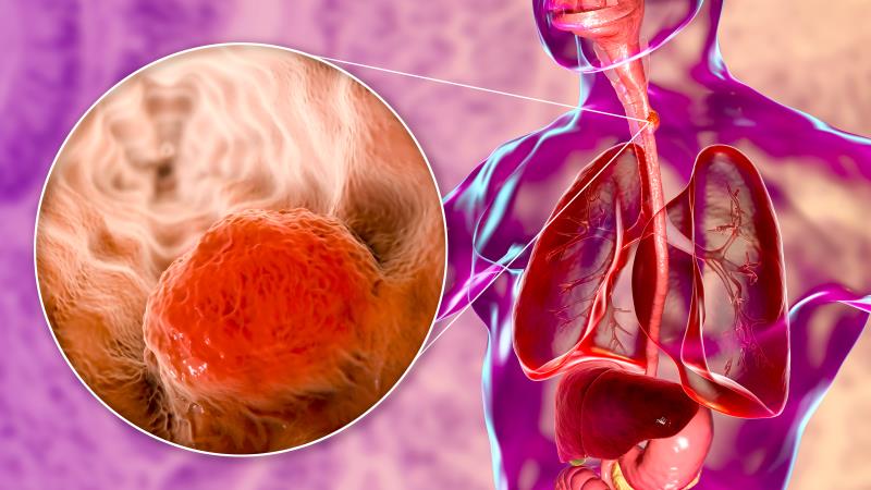 Second-line tislelizumab improves OS in advanced/metastatic ESCC in European/North American subgroup