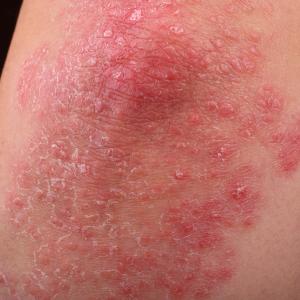 Patients with psoriasis, joint pain use more analgesics