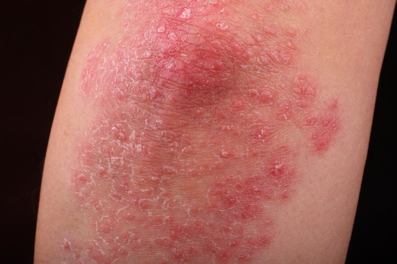 Changes in MetS diagnosis affects psoriasis risk