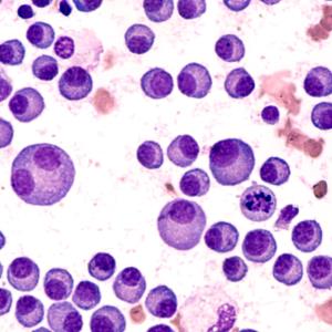 Multiple myeloma quadruplet prolongs survival, induces deeper responses