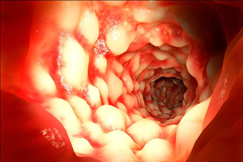 Vedolizumab safer than anti-TNFs for older IBD patients