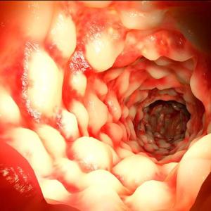 Stool-based bacteria as diagnostic biomarker in colorectal adenoma