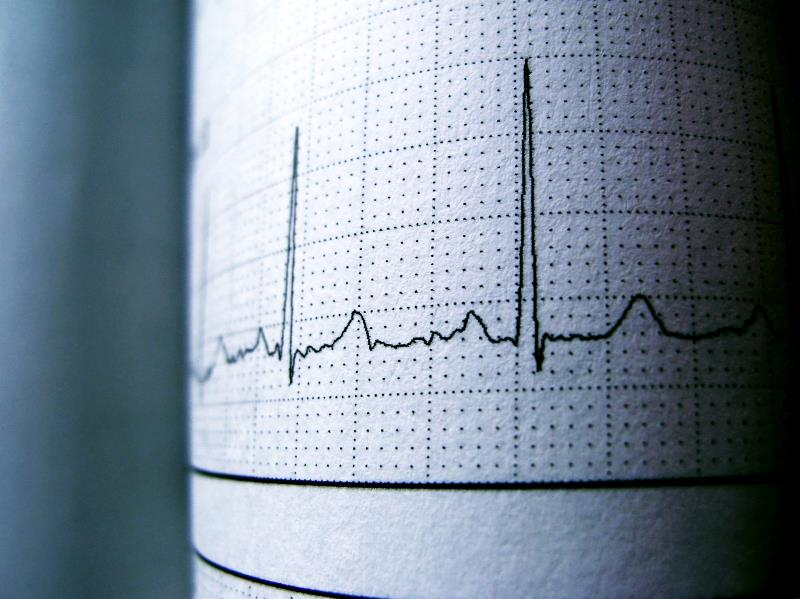 Severe QT prolongation rare with bedaquiline-based treatment for drug-resistant TB