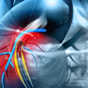 Cardiovascular instability, consciousness level tied to in-hospital mortality after PCI