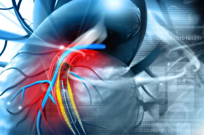 Cardiovascular instability, consciousness level tied to in-hospital mortality after PCI