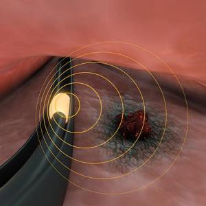 Shortened brachytherapy course proves its worth in endometrial cancer