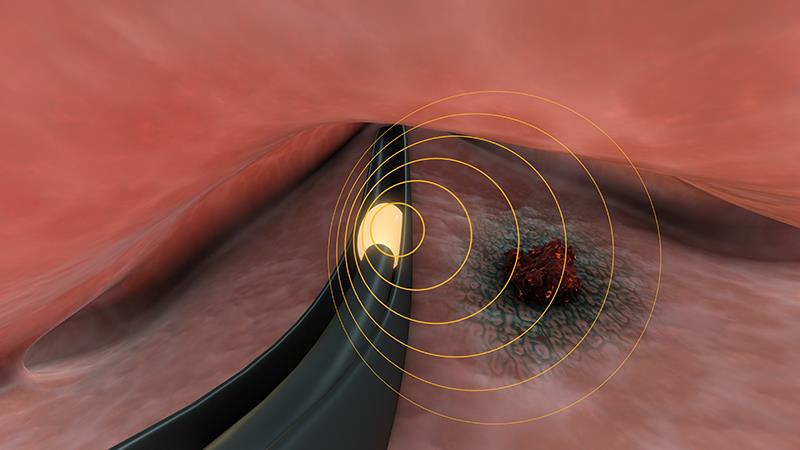 Shortened brachytherapy course proves its worth in endometrial cancer