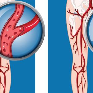 Clinical insights on best medical therapy for peripheral artery disease