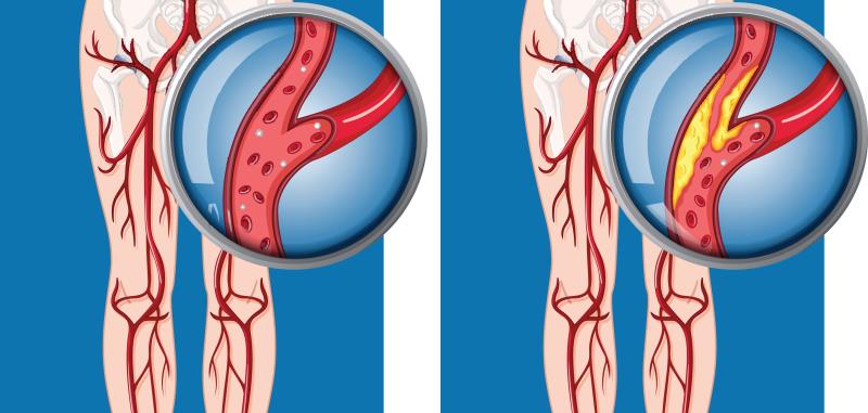 Clinical insights on best medical therapy for peripheral artery disease