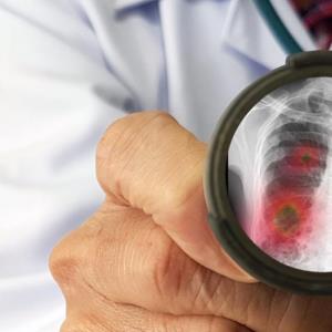 Pneumonitis history linked to ICI/chemo-related pneumonitis in NSCLC patients