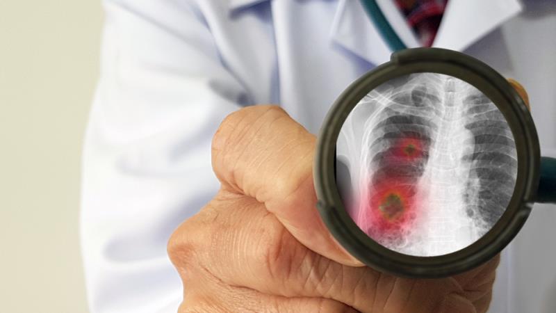 Pneumonitis history linked to ICI/chemo-related pneumonitis in NSCLC patients