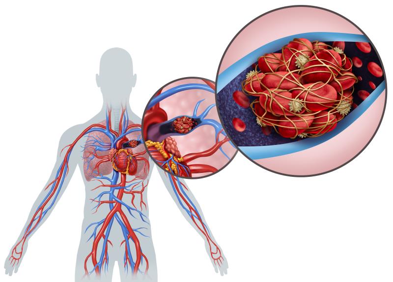 The role of apixaban in managing venous thromboembolism