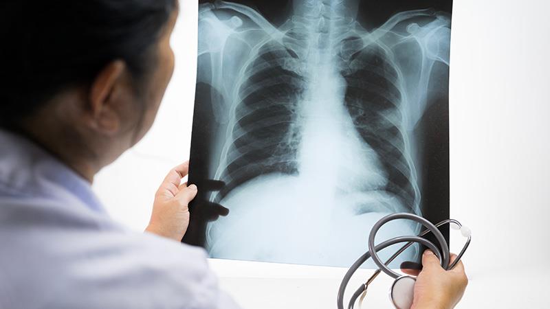 The study found that normal chest radiographic findings were five to six times more frequent in students aged ≤18.
